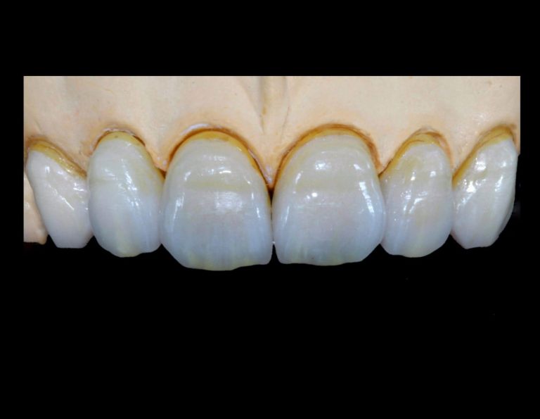 Labdental Puig Prótesis fija