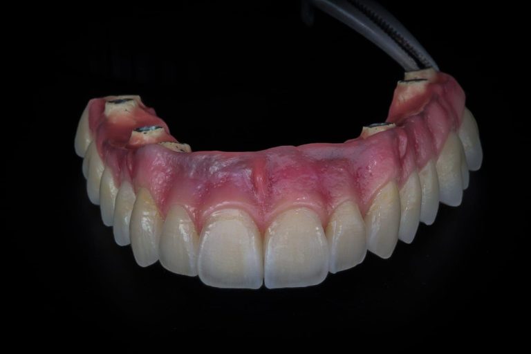 Labdental Puig Prótesis Fija Sobre Implantes
