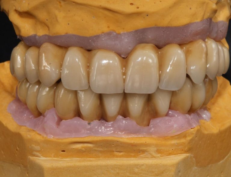 Labdental Puig Prótesis Fija Sobre Implantes