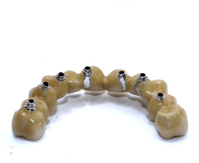 Labdental Puig Prótesis Fija Sobre Implantes