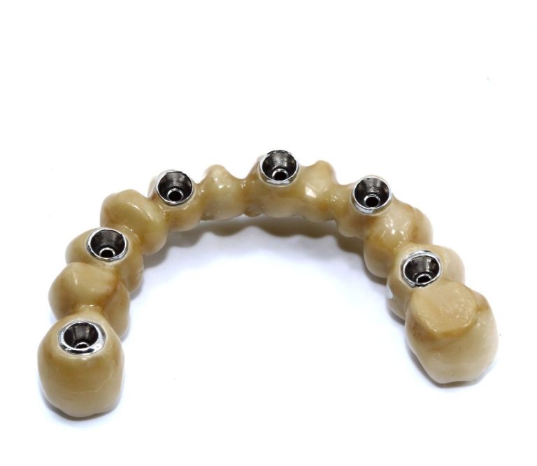 Labdental Puig Prótesis Fija Sobre Implantes