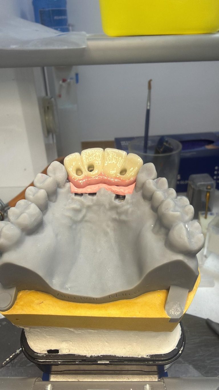 Labdental Puig Prótesis Fija Sobre Implantes