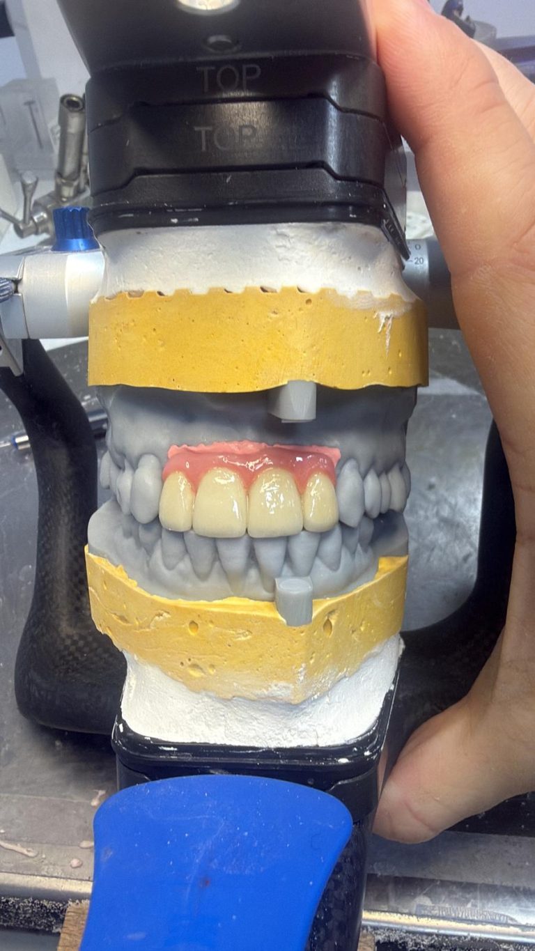 Labdental Puig Prótesis Fija Sobre Implantes