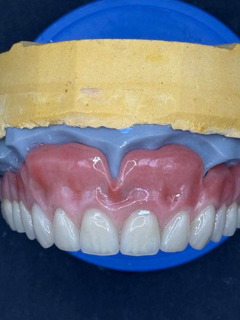 Labdental Puig Prótesis Removibles