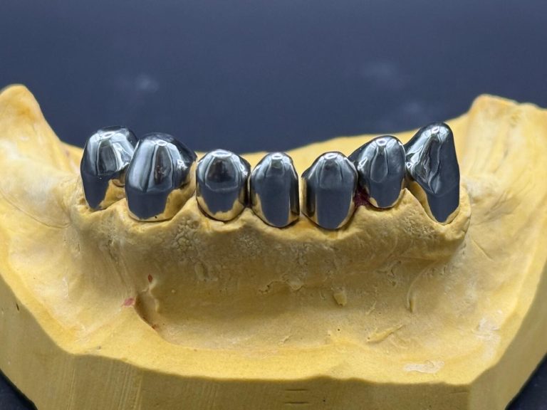 Labdental Puig Prótesis Telescópicas