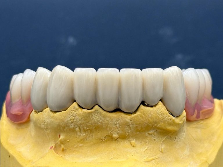 Labdental Puig Prótesis Telescópicas