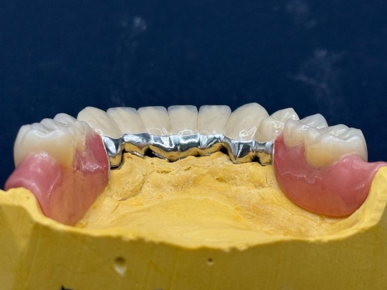 Labdental Puig Prótesis Telescópicas