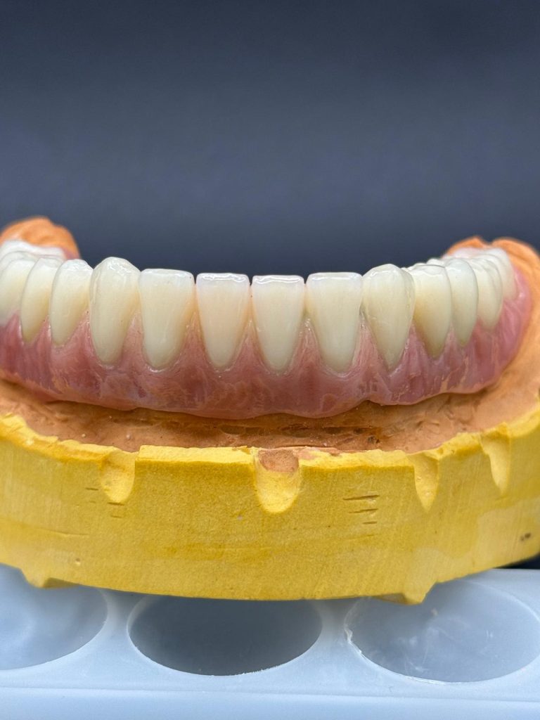 Labdental Puig Prótesis Telescópicas