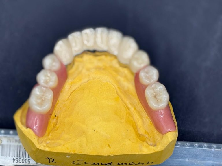 Labdental Puig Prótesis Telescópicas